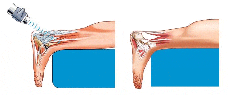 Plantar fasciitis hot sale electrotherapy treatment