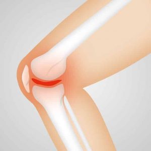 Arthritis pain treat with physiotherapy