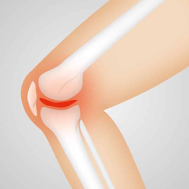 Arthritis pain? treat it with physiotherapy