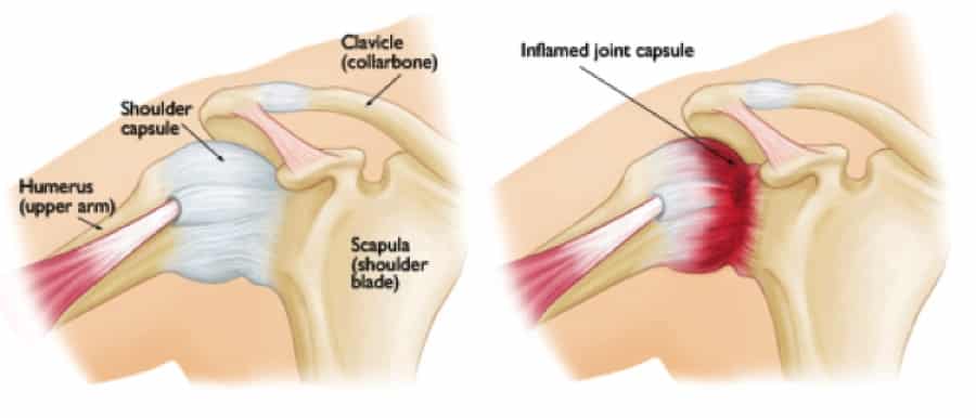 physiotherapy treat frozen shoulder