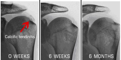 Shoulder Pain — Shockwave Therapy