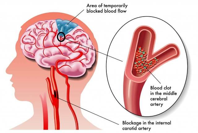 stroke blood blocked flow