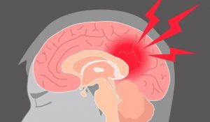 physiotherapy helps stroke