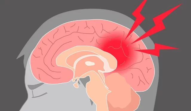 Physiotherapy After Stroke