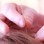 How Acupuncture Can Help You How Acupuncture Can Help You
