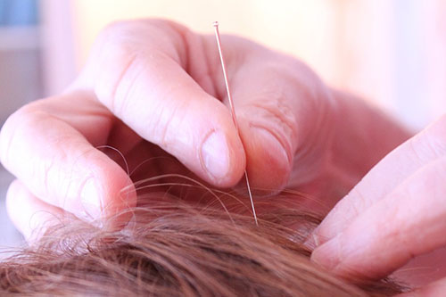 How Acupuncture Can Help You