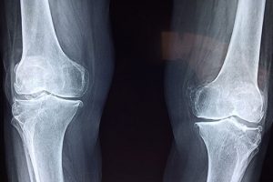 physiotherapy treats joint injury