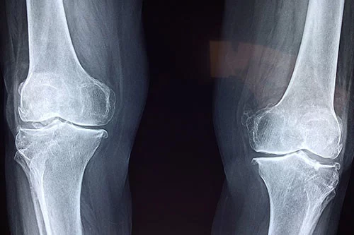 Why Physiotherapy is Vital in Treating Joint Injuries