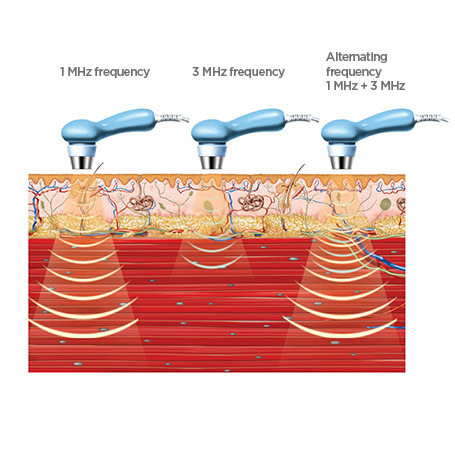 Ultrasonic therapy machine: Types, Effects, Indications