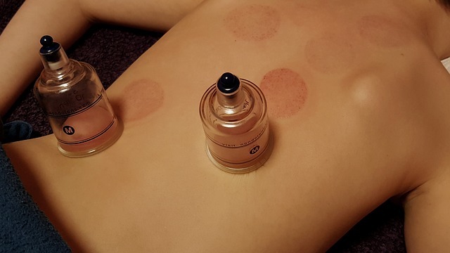 Cupping Therapy traditional chinese medicine