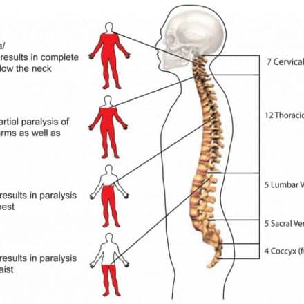 Spinal Cord Injury physiotherapy