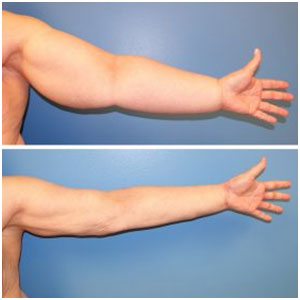 lymphedema physiotherapy