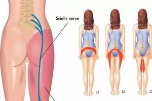 sciatica symptoms