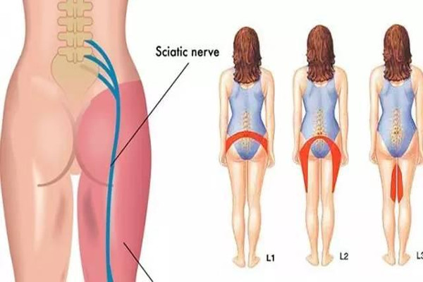 The Role of Physiotherapy in Sciatica