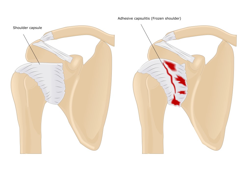 frozen-shoulder-adhesions-calcification