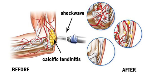 shockwave breaking calcific tendinitis