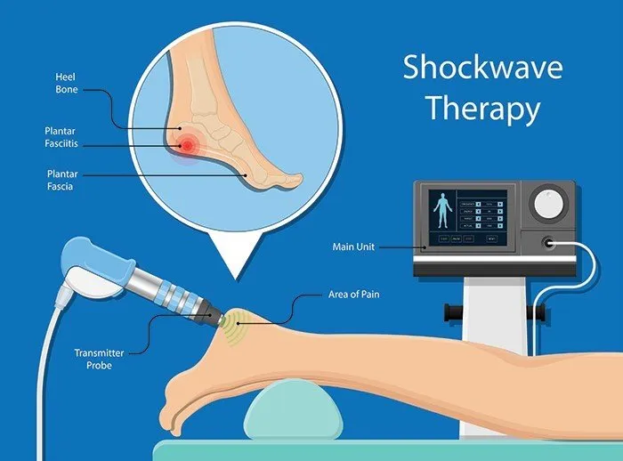 shockwave therapy plantar fasciitis