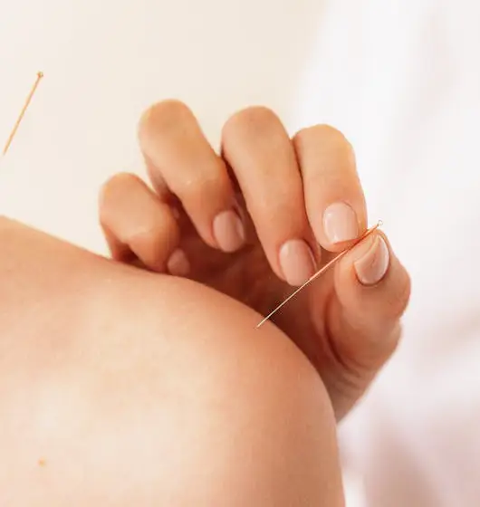 physiotherapy service in Pickering and Milton acupuncture-pickering-milton